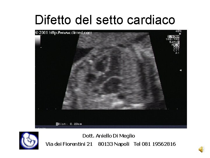 Difetto del setto cardiaco Dott. Aniello Di Meglio Via dei Fiorentini 21 80133 Napoli