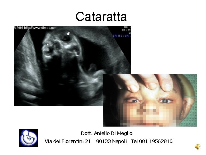 Cataratta Dott. Aniello Di Meglio Via dei Fiorentini 21 80133 Napoli Tel 081 19562816