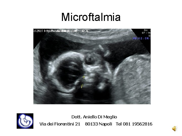 Microftalmia Dott. Aniello Di Meglio Via dei Fiorentini 21 80133 Napoli Tel 081 19562816