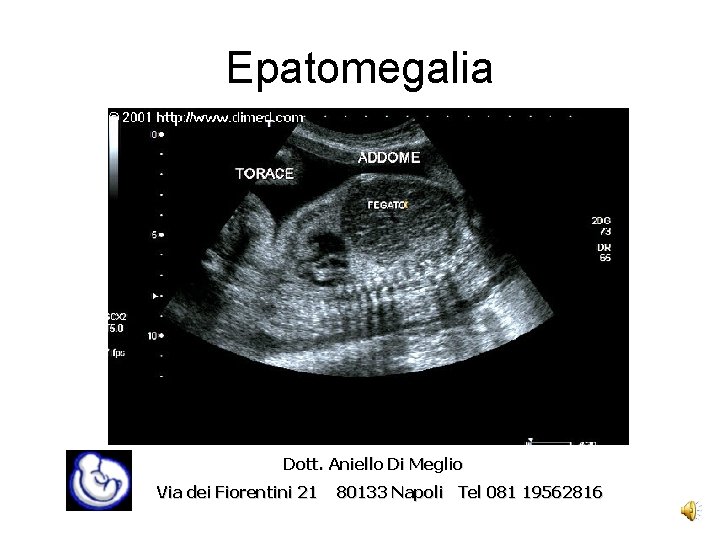 Epatomegalia Dott. Aniello Di Meglio Via dei Fiorentini 21 80133 Napoli Tel 081 19562816