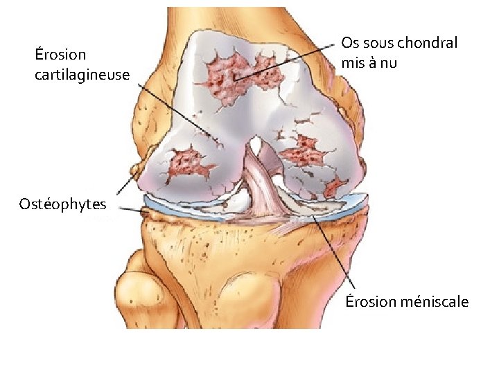 Érosion cartilagineuse Os sous chondral mis à nu Ostéophytes Érosion méniscale 