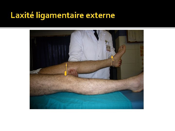 Laxité ligamentaire externe 