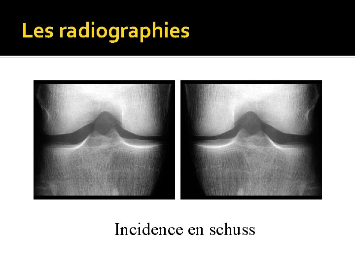 Les radiographies Incidence en schuss 