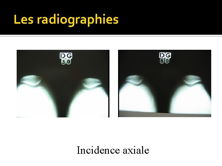 Les radiographies Incidence axiale 