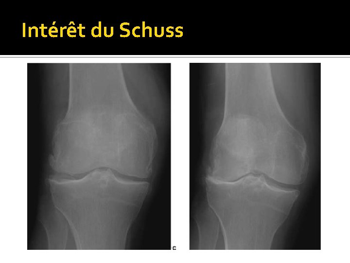 Intérêt du Schuss 