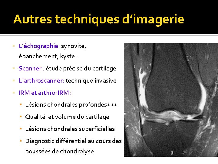 Autres techniques d’imagerie L’échographie: synovite, épanchement, kyste… Scanner : étude précise du cartilage L’arthroscanner: