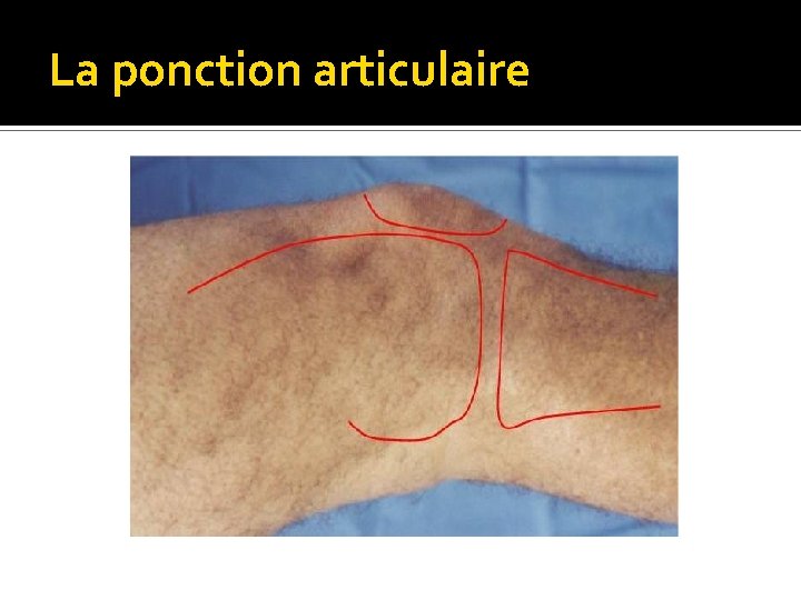 La ponction articulaire 
