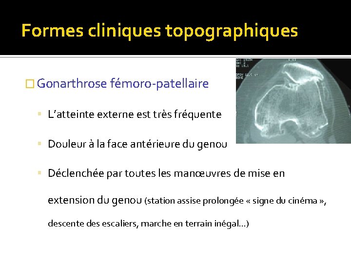 Formes cliniques topographiques � Gonarthrose fémoro-patellaire L’atteinte externe est très fréquente Douleur à la