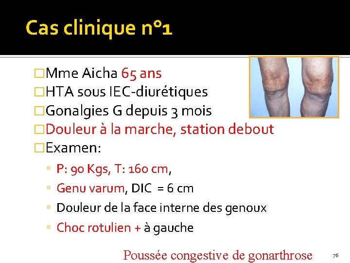 Cas clinique n° 1 �Mme Aicha 65 ans �HTA sous IEC-diurétiques �Gonalgies G depuis