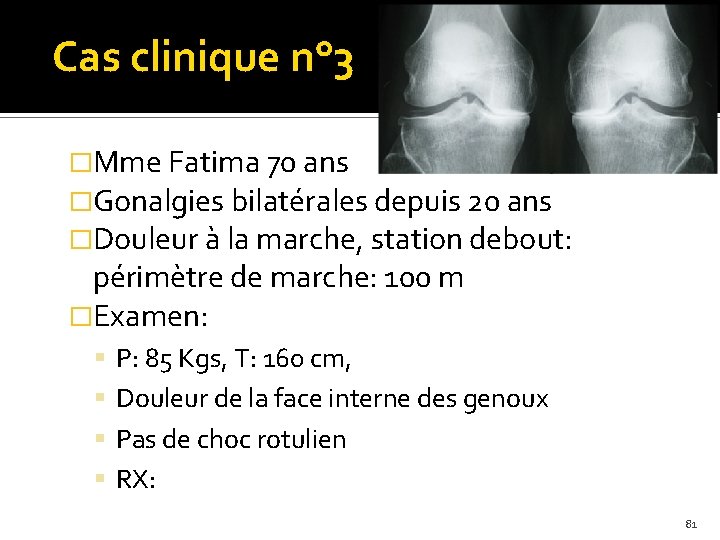Cas clinique n° 3 �Mme Fatima 70 ans �Gonalgies bilatérales depuis 20 ans �Douleur