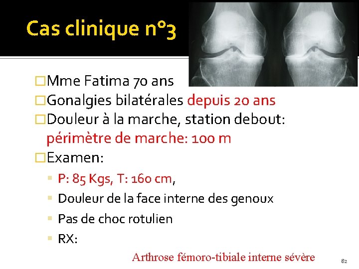 Cas clinique n° 3 �Mme Fatima 70 ans �Gonalgies bilatérales depuis 20 ans �Douleur