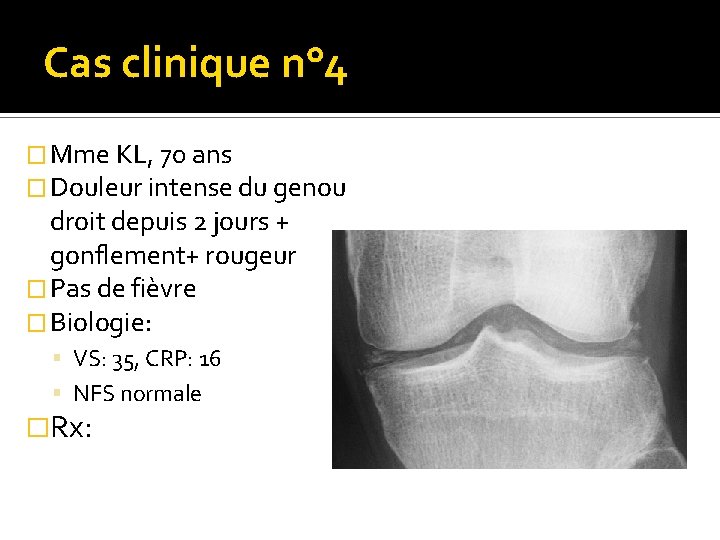 Cas clinique n° 4 � Mme KL, 70 ans � Douleur intense du genou