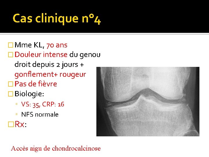 Cas clinique n° 4 � Mme KL, 70 ans � Douleur intense du genou