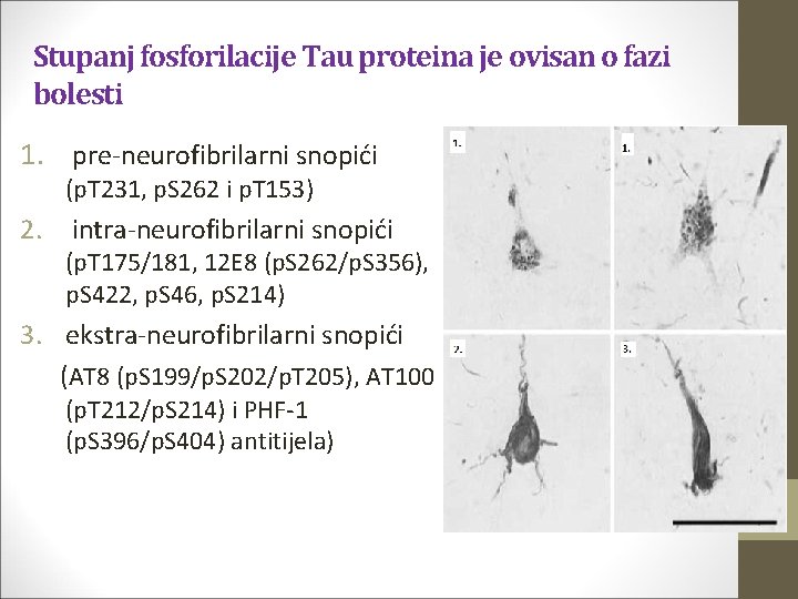 Stupanj fosforilacije Tau proteina je ovisan o fazi bolesti 1. pre-neurofibrilarni snopići (p. T