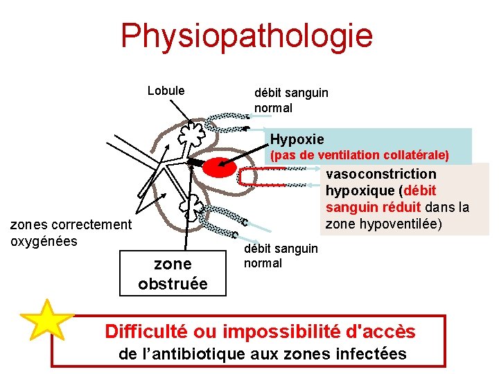 Physiopathologie Lobule débit sanguin normal Hypoxie (pas de ventilation collatérale) vasoconstriction hypoxique (débit sanguin