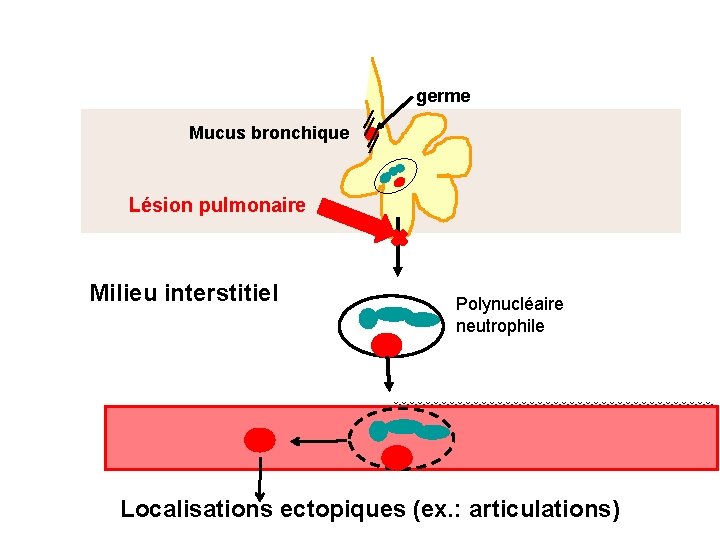 germe Mucus bronchique Lésion pulmonaire Milieu interstitiel Polynucléaire neutrophile Localisations ectopiques (ex. : articulations)