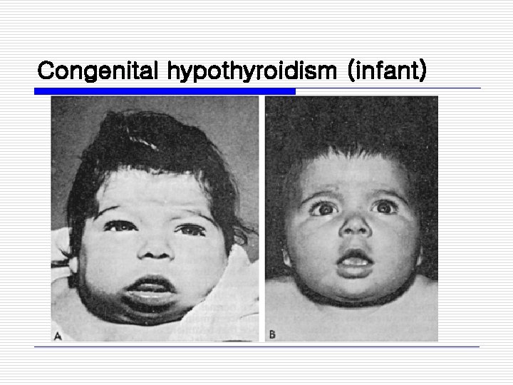 Congenital hypothyroidism (infant) 