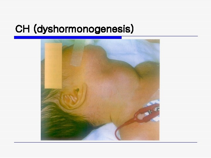 CH (dyshormonogenesis) 