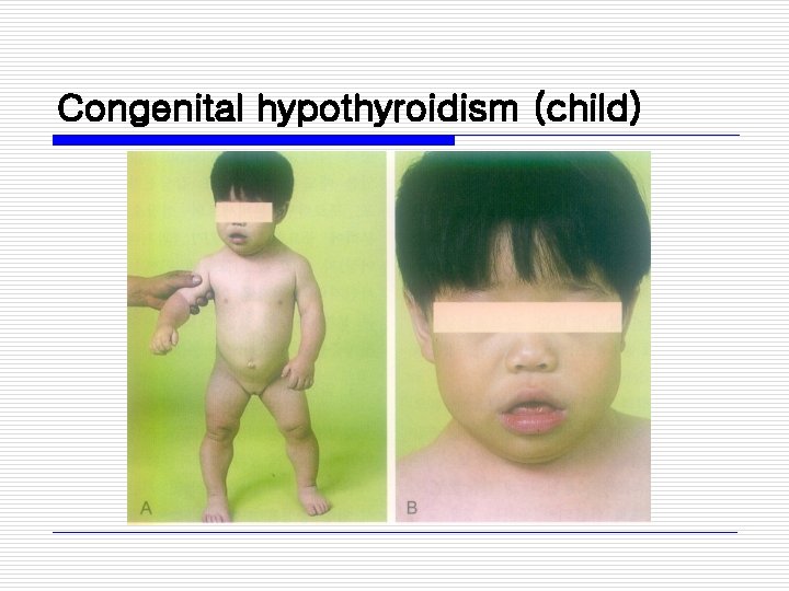 Congenital hypothyroidism (child) 