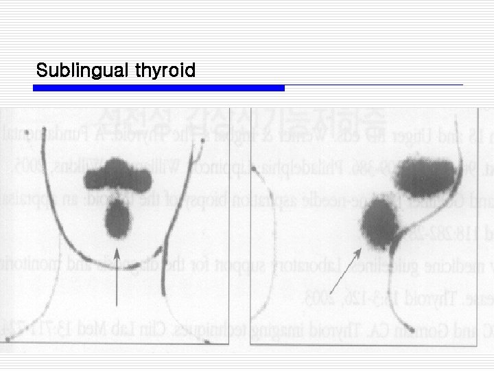 Sublingual thyroid 