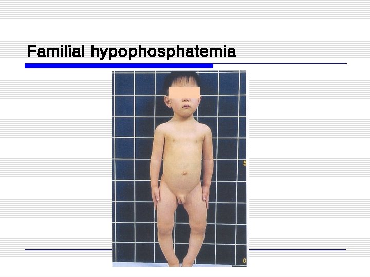 Familial hypophosphatemia 