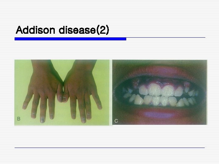 Addison disease(2) 