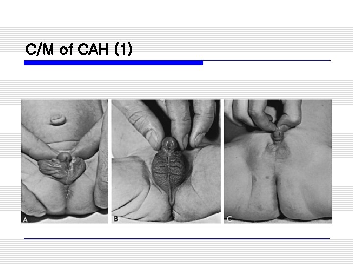 C/M of CAH (1) 