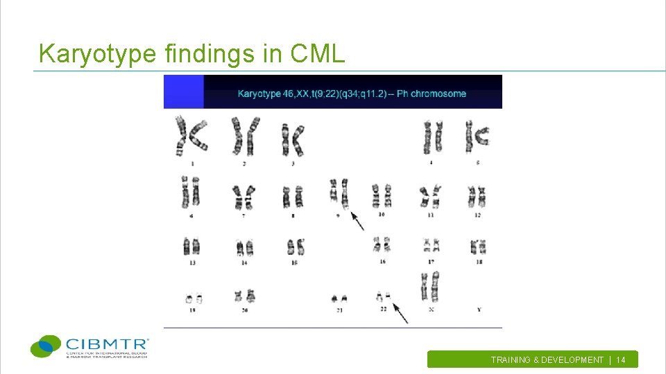 Karyotype findings in CML TRAINING & DEVELOPMENT | 14. 