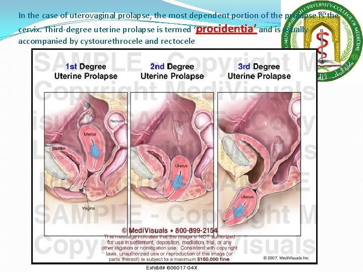 In the case of uterovaginal prolapse, the most dependent portion of the prolapse is