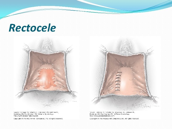 Rectocele  Rectocele