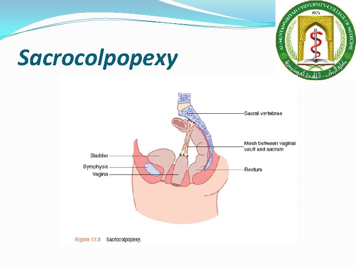 Sacrocolpopexy  Sacrocolpopexy
