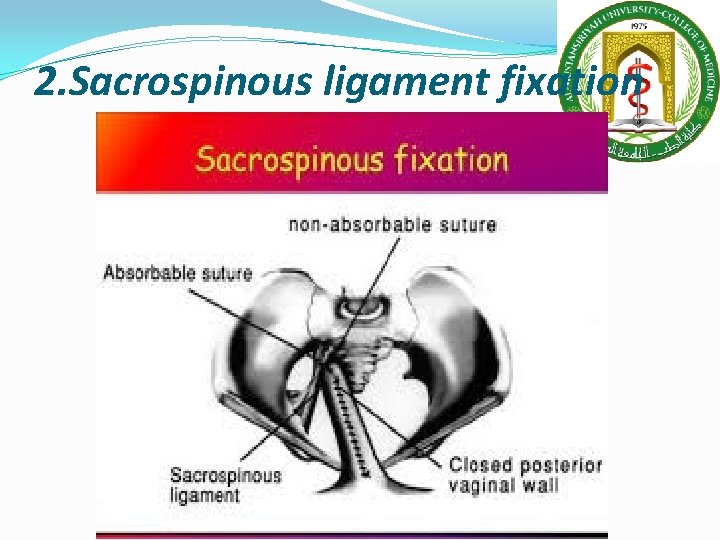 2. Sacrospinous ligament fixation 