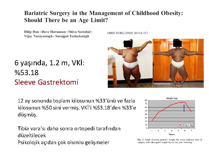 6 yaşında, 1. 2 m, VKİ: %53. 18 Sleeve Gastrektomi 12 ay sonunda toplam