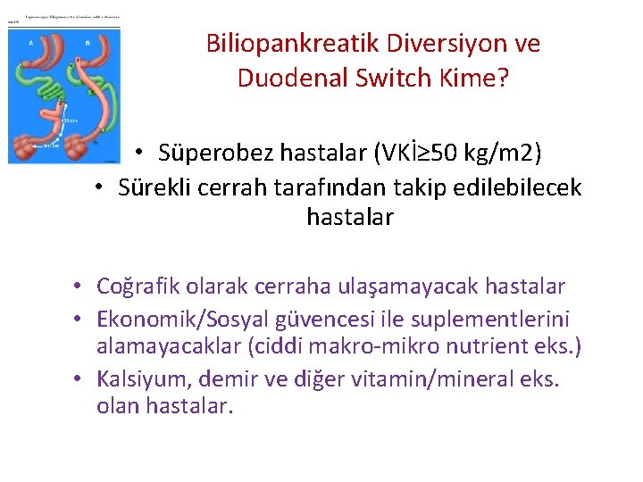 Biliopankreatik Diversiyon ve Duodenal Switch Kime? • Süperobez hastalar (VKİ≥ 50 kg/m 2) •