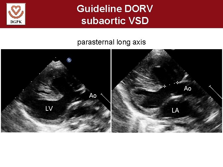 Guideline DORV subaortic VSD parasternal long axis Ao Ao LV LA 