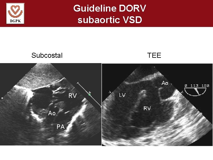 Guideline DORV subaortic VSD Subcostal TEE RV Ao PA 