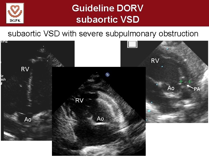 Guideline DORV subaortic VSD with severe subpulmonary obstruction RV RV Ao Ao PA 