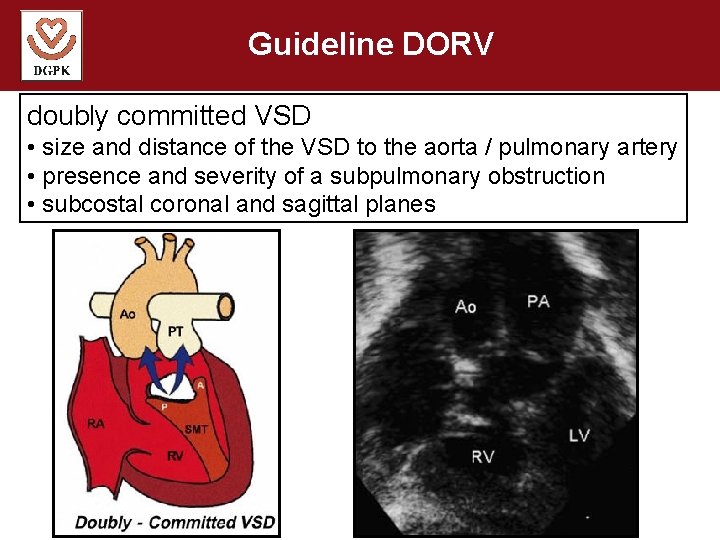 Guideline DORV doubly committed VSD • size and distance of the VSD to the