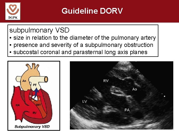 Guideline DORV subpulmonary VSD • size in relation to the diameter of the pulmonary