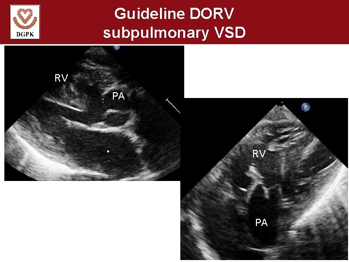 Guideline DORV subpulmonary VSD RV PA 