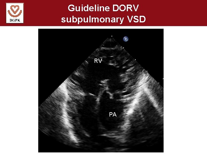 Guideline DORV subpulmonary VSD RV PA 