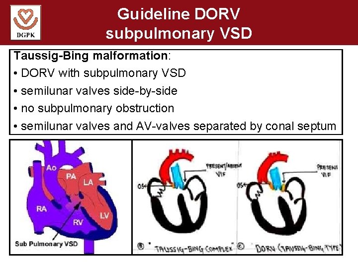 Guideline DORV subpulmonary VSD Taussig-Bing malformation: • DORV with subpulmonary VSD • semilunar valves