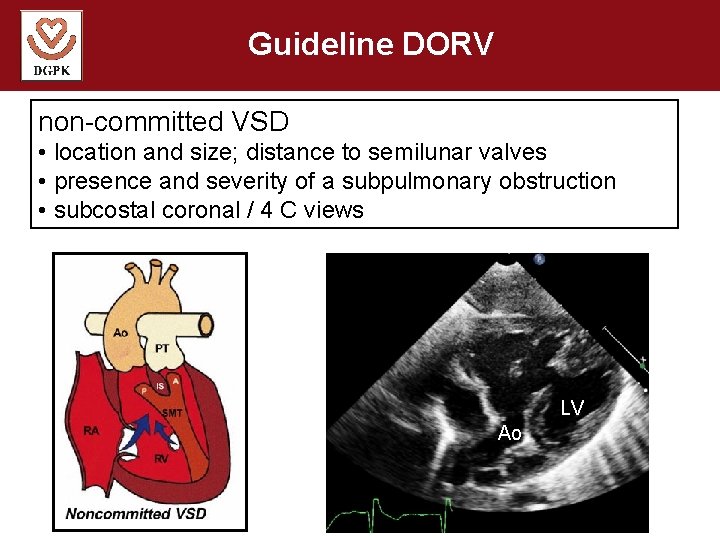 Guideline DORV non-committed VSD • location and size; distance to semilunar valves • presence