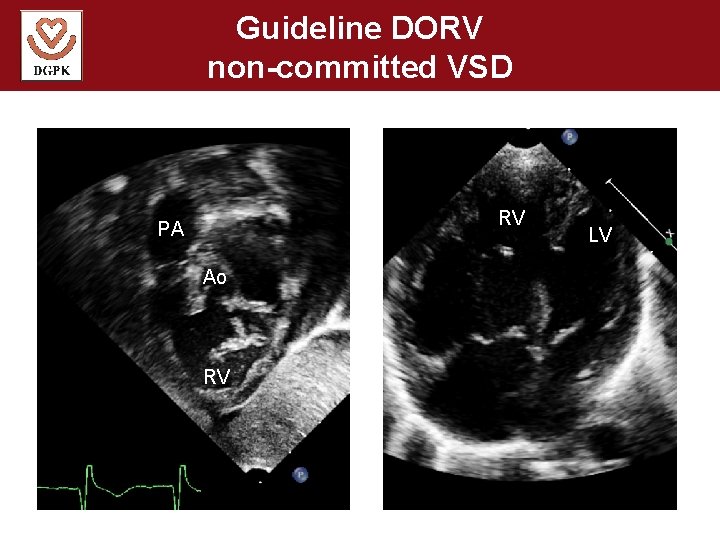 Guideline DORV non-committed VSD RV PA Ao RV LV 
