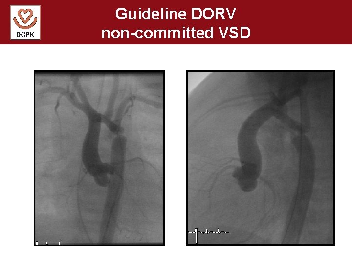 Guideline DORV non-committed VSD 