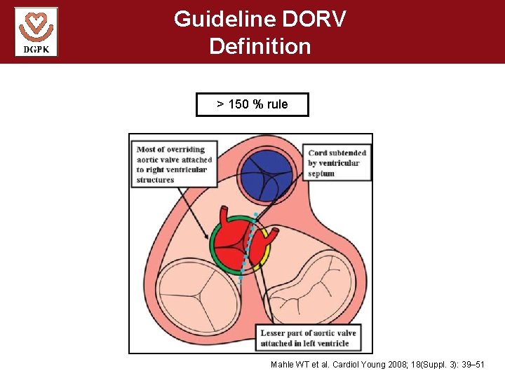 Guideline DORV Definition > 150 % rule Mahle WT et al. Cardiol Young 2008;