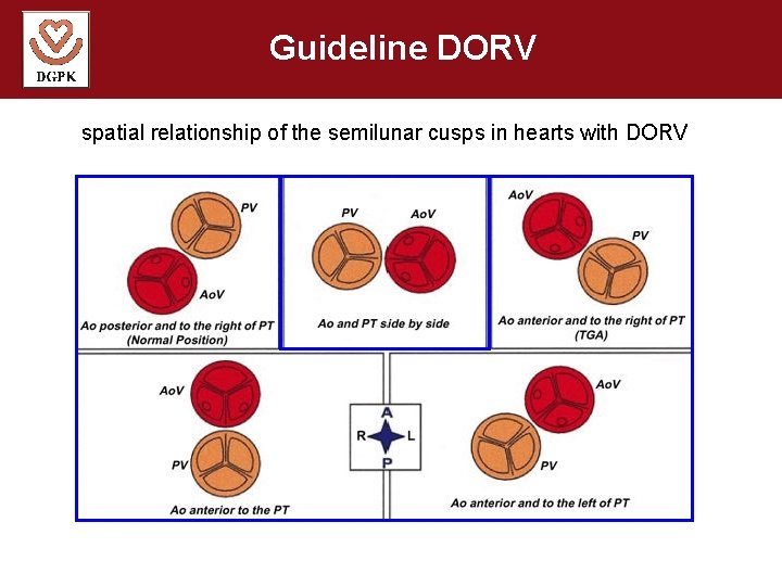 Guideline DORV spatial relationship of the semilunar cusps in hearts with DORV 