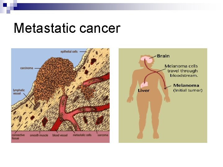 Metastatic cancer 