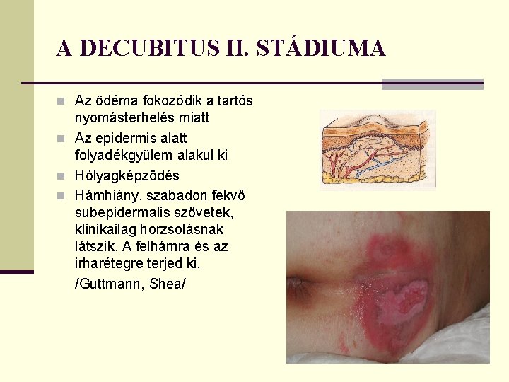 A DECUBITUS II. STÁDIUMA n Az ödéma fokozódik a tartós nyomásterhelés miatt n Az