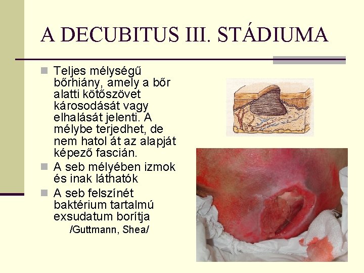 A DECUBITUS III. STÁDIUMA n Teljes mélységű bőrhiány, amely a bőr alatti kötőszövet károsodását